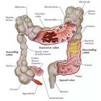 About Colon Cleaning
