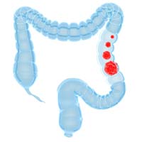 Colon Cleansing
