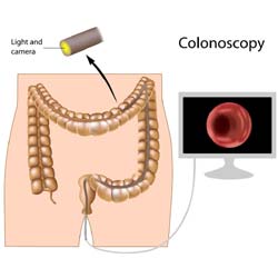 Colonoscopy Colonoscopy