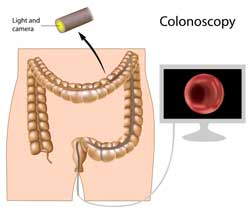 The Risks Involved in Colonoscopy Procedure