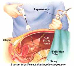 Laparoscopic Surgery