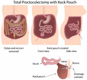 K Pouch