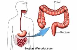 Partial Colectomy