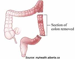 Resection