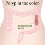 Types of Colon Polyps: Risk for Colon Cancer