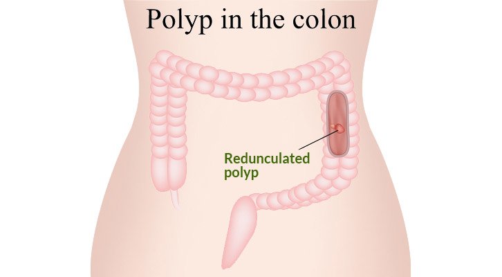 Types of Colon Polyps: Risk for Colon Cancer