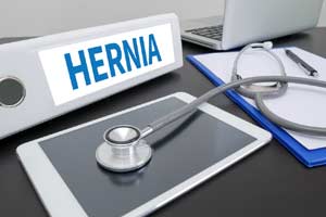 Things about Hernia