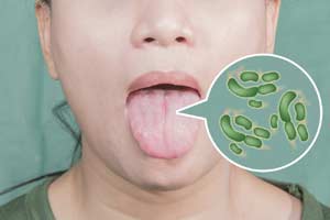 Oral Bacteria Can Make Colon Cancer Worse